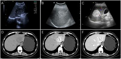 Hepatic perivascular epithelioid cell tumor: a retrospective analysis of 36 cases